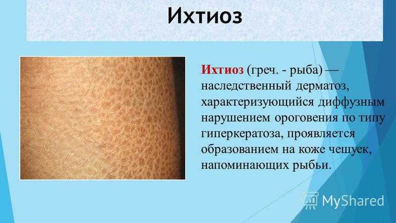 Б6 болезнь. Ихтиоз и ихтиозные поражения кожи. Ихтиоз наследственное заболевание.
