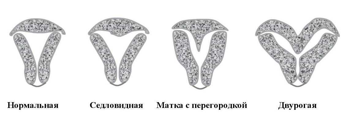Рак тела матки (рак эндометрия)