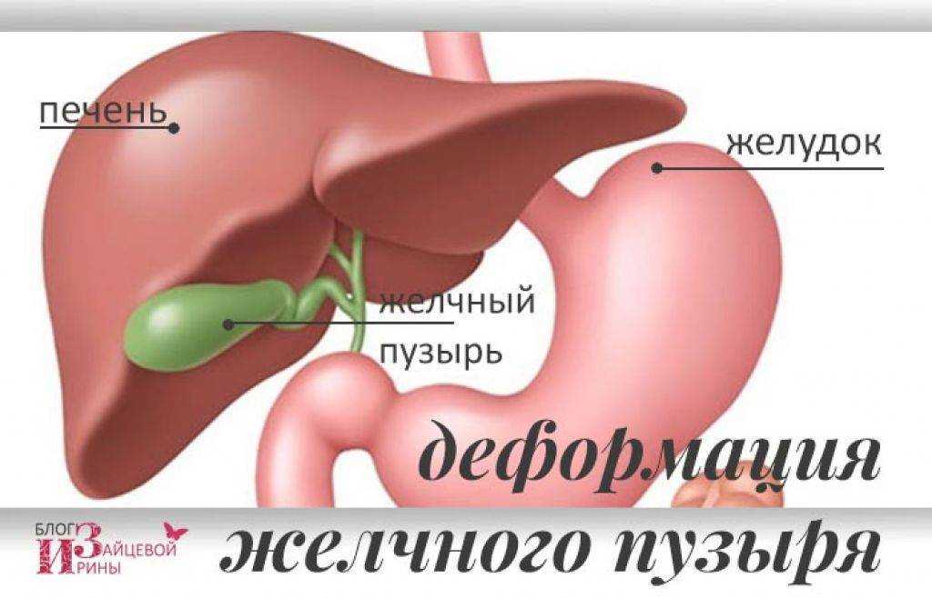 Деформация желчного пузыря у ребенка: симптомы, причины и эффективные методы лечения