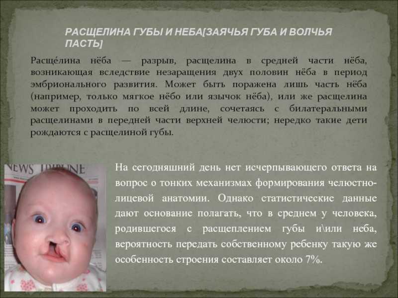 Заячья губа и волчья пасть