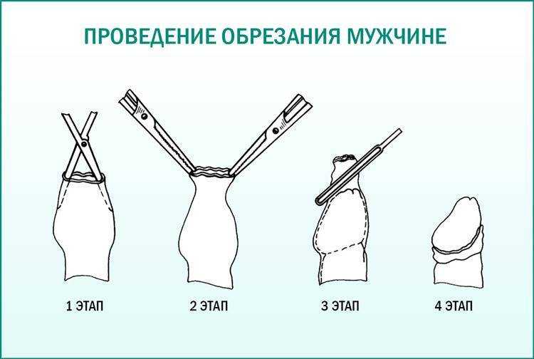 Фимоз в вопросах и ответах