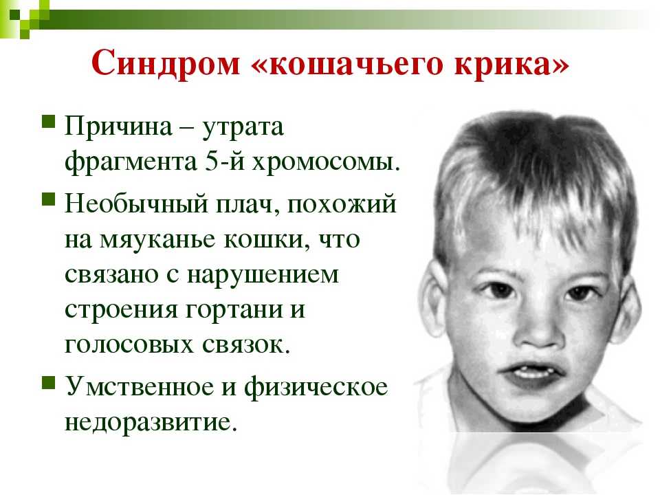 Что такое синдром кошачьего крика? | аборт в спб