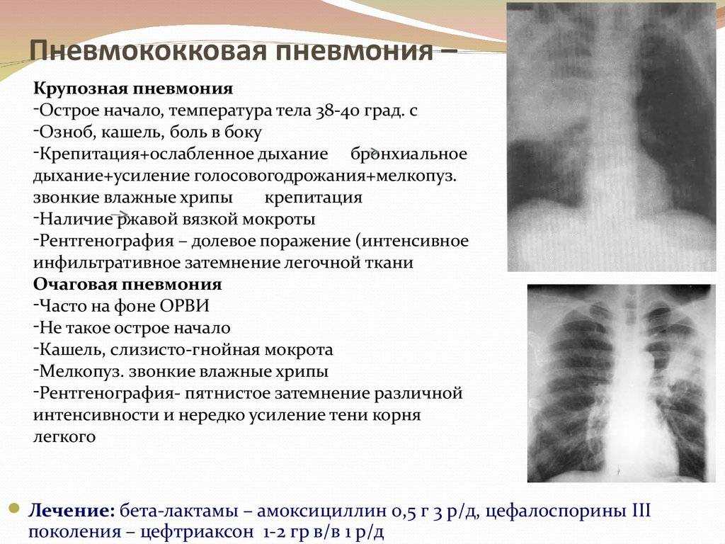 Прикорневая пневмония у детей: симптомы, диагностика и лечение