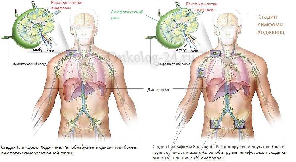 Стадии лимфом. Лимфома Ходжкина лимфоузлы. Стадии лимфомы Ходжкина. Онкология лимфатических узлов.