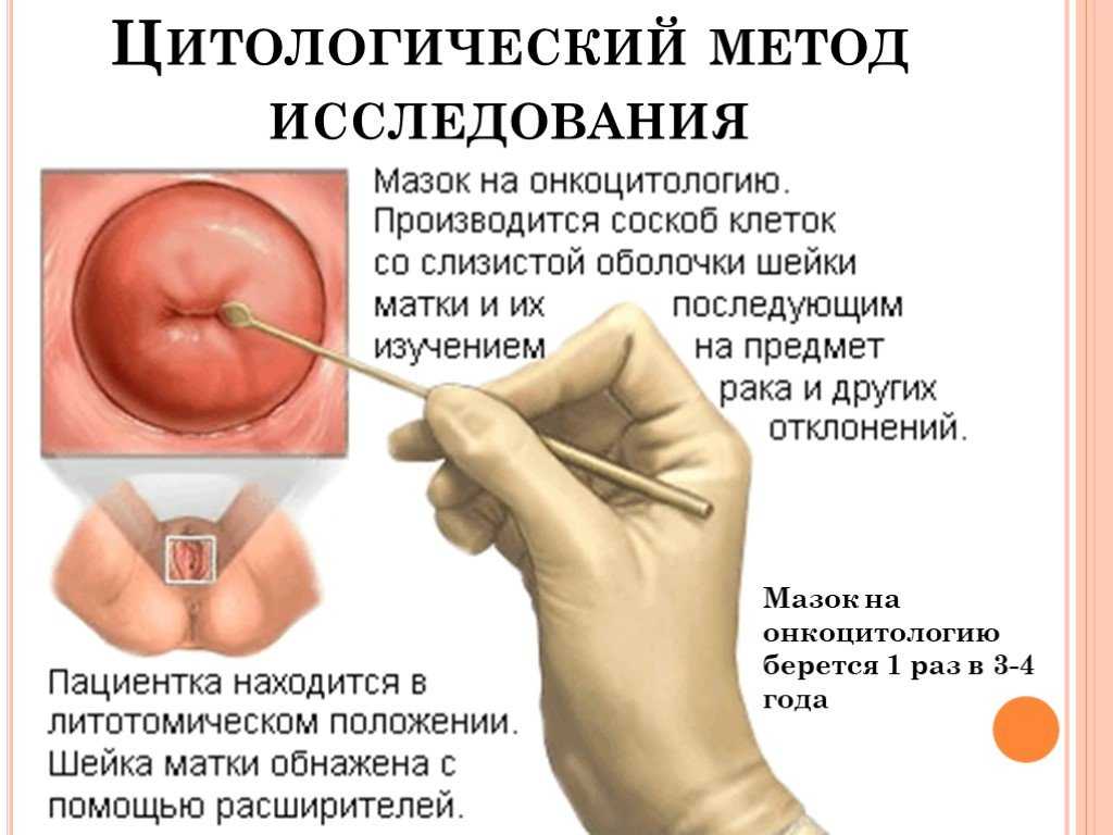 Мазок из влагалища: какие заболевания показывает, как берут мазок из влагалища, где сдать, куда обратиться, значение букв, расшифровка, видео