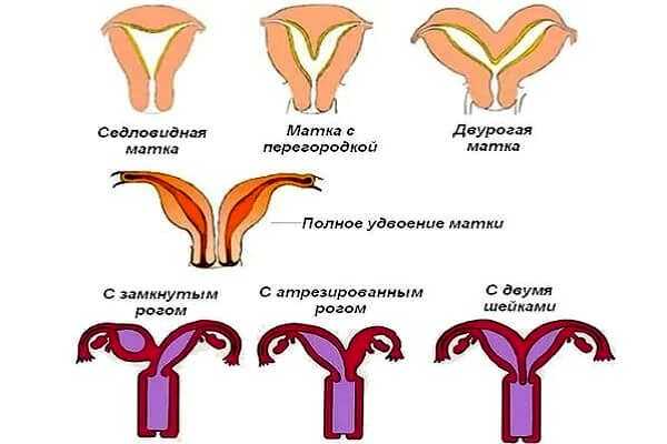 Форма матки. Двурогая седловидная матка. Двурогая матка и обычная.