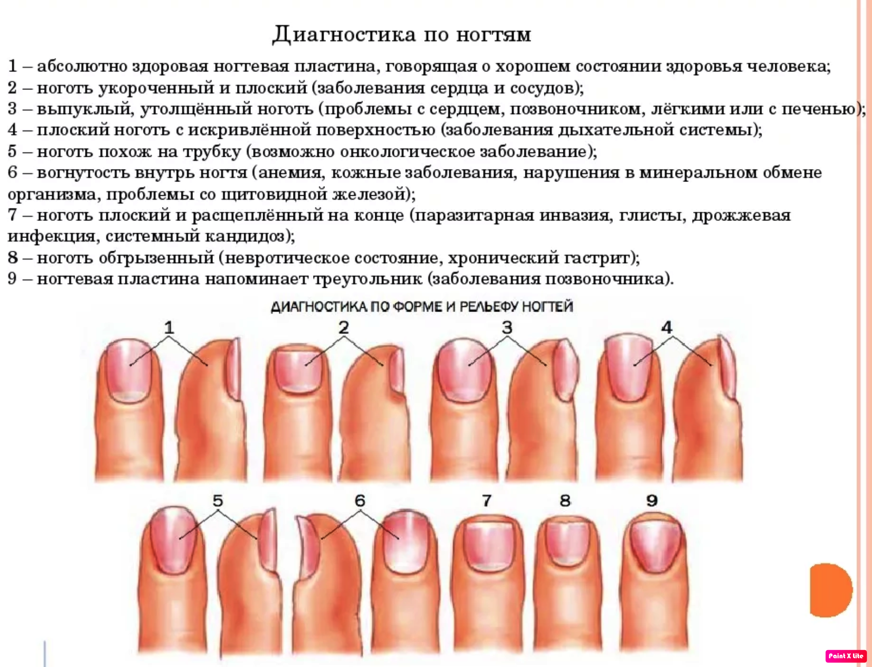 Почему ногти становятся жесткими. Определение болезни по состоянию ногтей. Ногти болезни организма по ногтям на руках. Выявление болезни по ногтям. Диагноз заболеваний по ногтям.