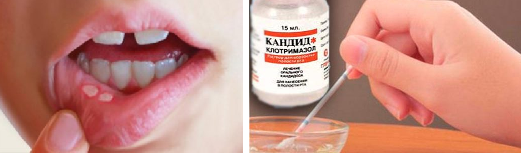 Афтозный стоматит у детей: причины, симптомы и методы лечения с фото