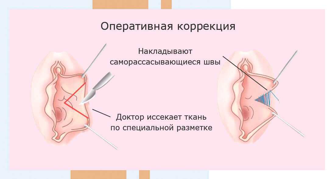 Высыпание на головке полового члена