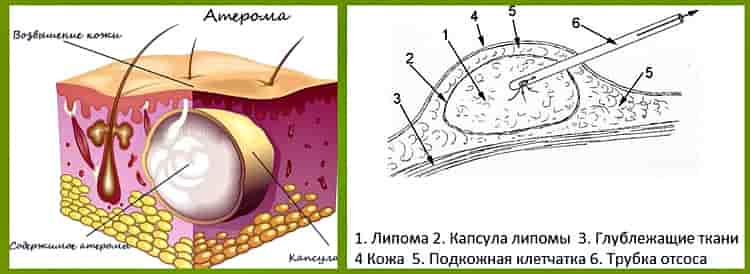 Акне