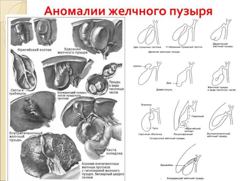 Деформация желчного пузыря у ребёнка: симптомы, причины, лечение