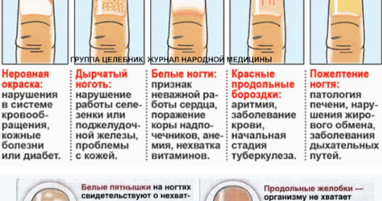 Патология ногтевых пластин