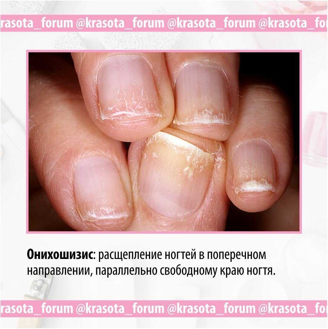 Что ногти говорят о состоянии здоровья человека: фото, диагностика проблем по виду ногтей