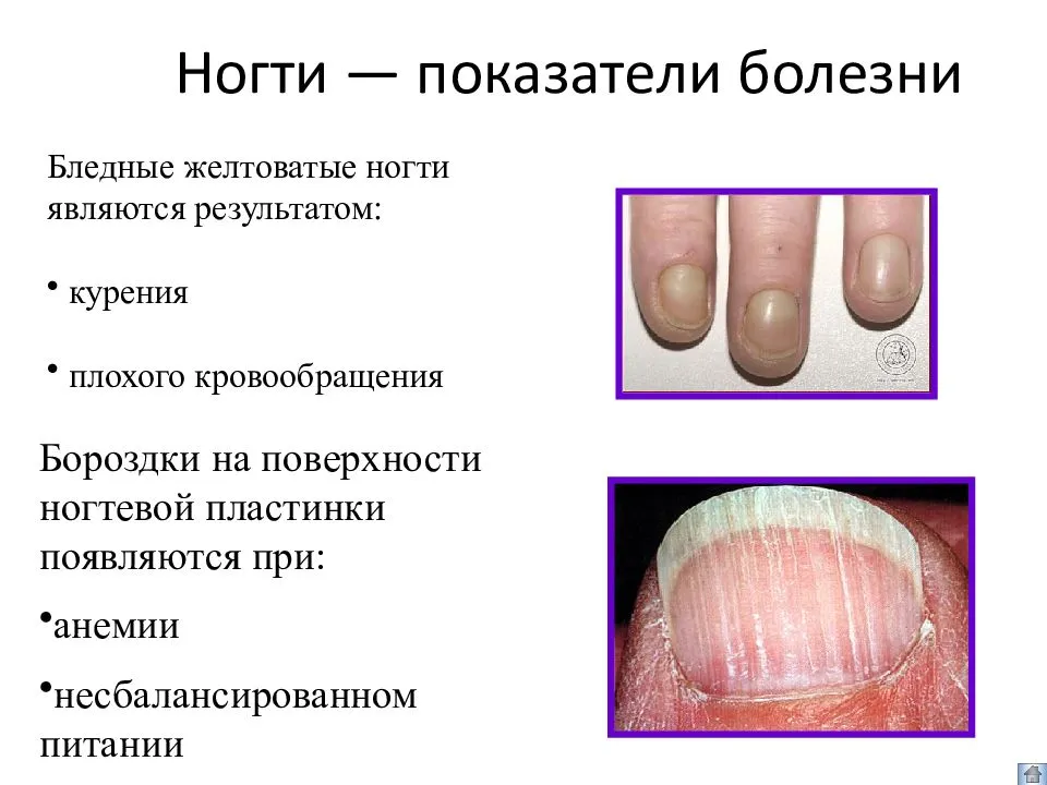 Почему загибаются ногти на руках (вниз и вверх): причины, что делать, как исправить