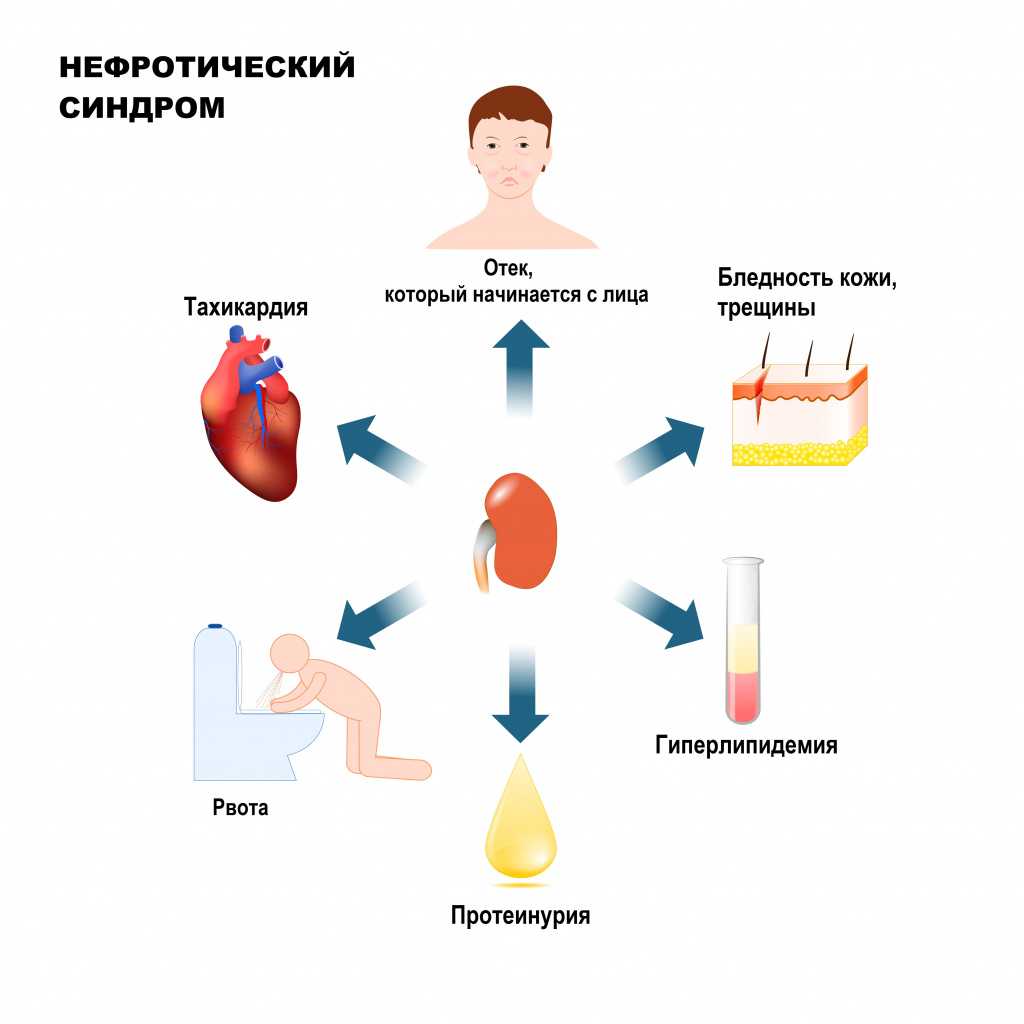 Синдром альпорта (наследственный нефрит): настораживающие симптомы, диагностика и выбор лечения