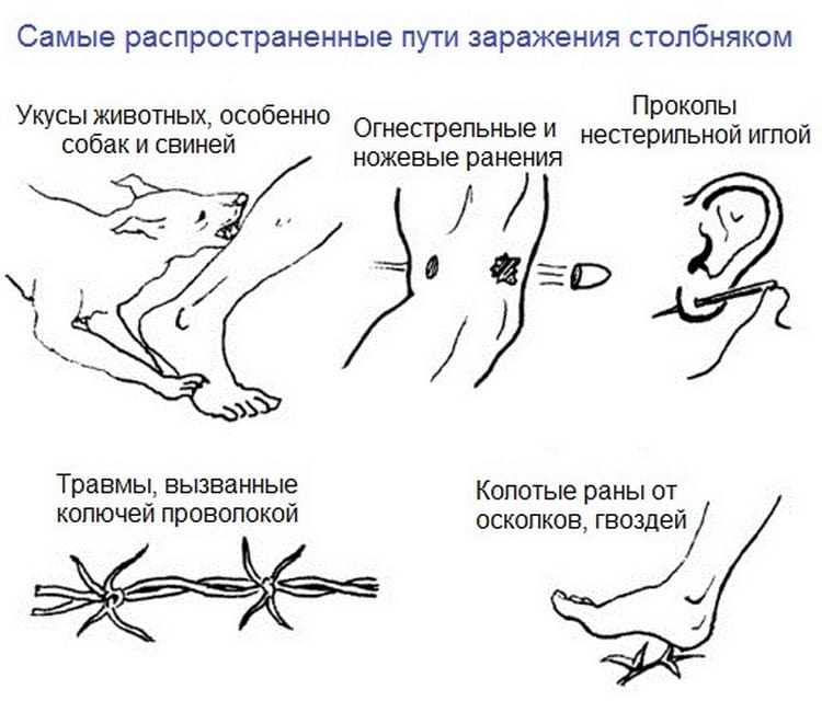 Симптомы столбняка у детей