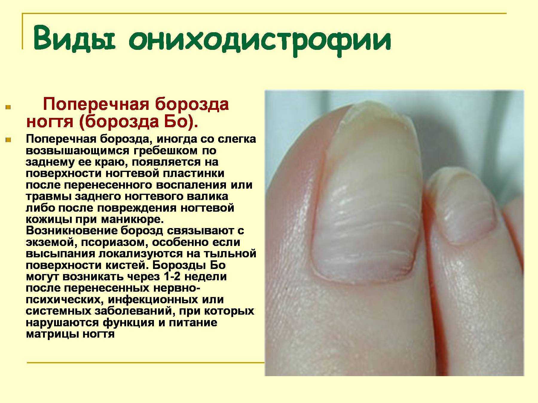 Полоски на ногтях причины вертикальные у женщин. Попеперечные борозды на ногте. Поперечные борозды на ногтях. Продольные и поперечные борозды на ногтях.
