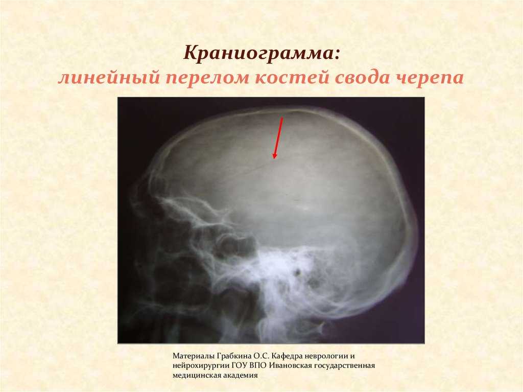 Замедленно консолидирующиеся переломы