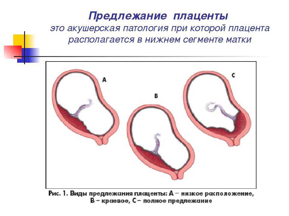 Предлежание плаценты при беременности - причины, признаки, симптомы и лечение