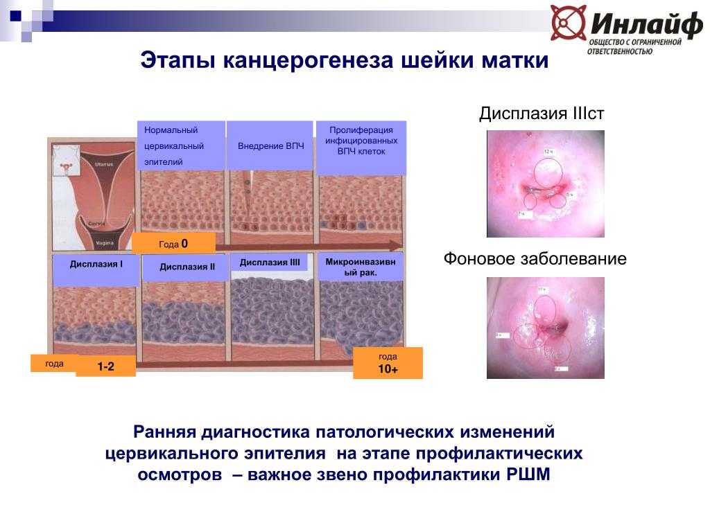 Впч и рак шейки матки презентация