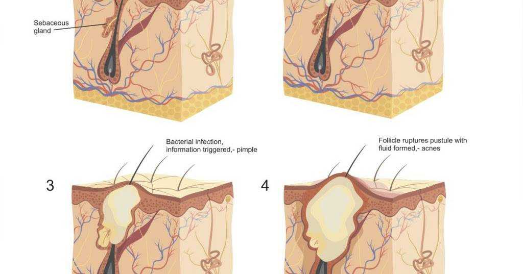 Воспаление канала у мужчин. Атерома киста сальной железы. Атерома волосяного фолликула. Гиперплазия сальных желез.