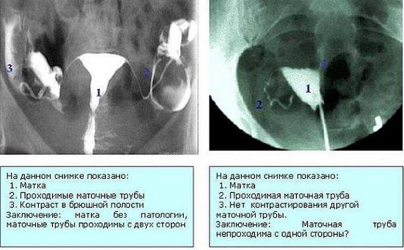 Гистеросальпингография — результаты, стоимость | беременность после процедуры