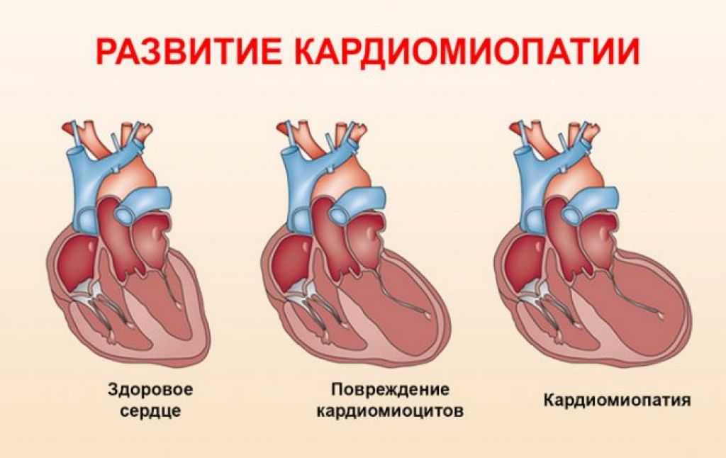 Функциональная кардиопатия у детей: распространенность заболевания