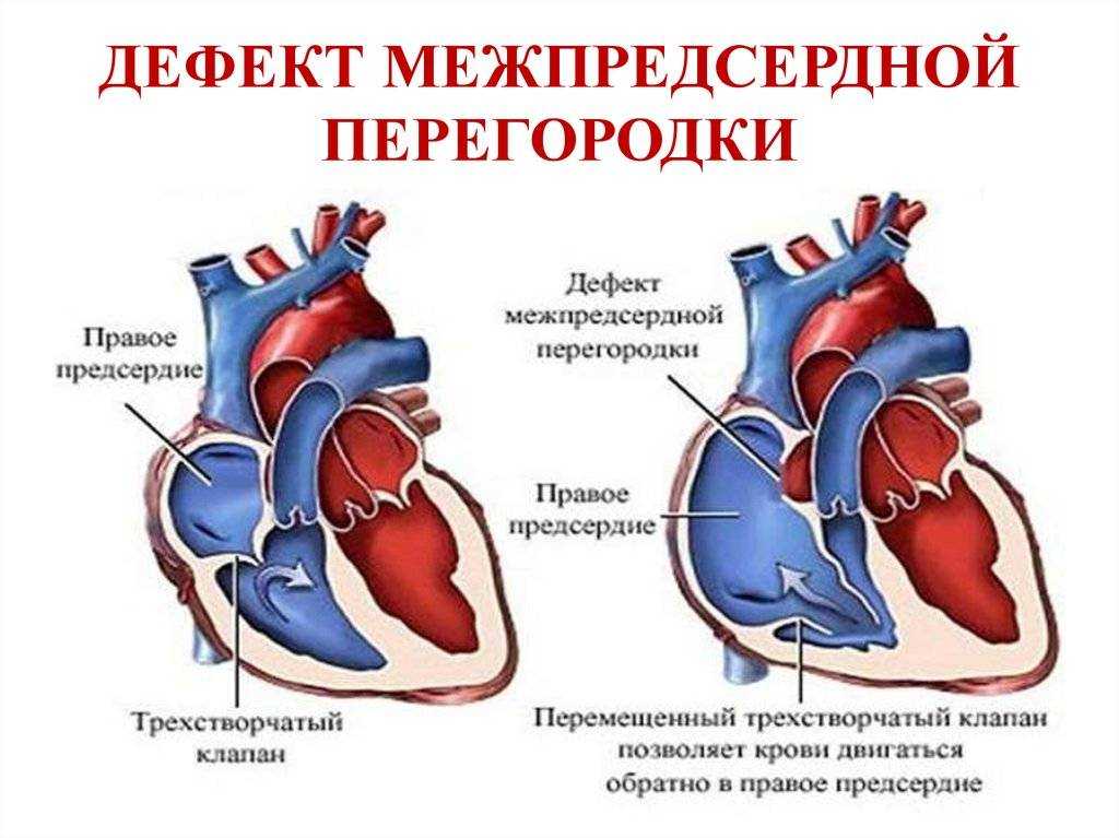 Дмпп у детей презентация