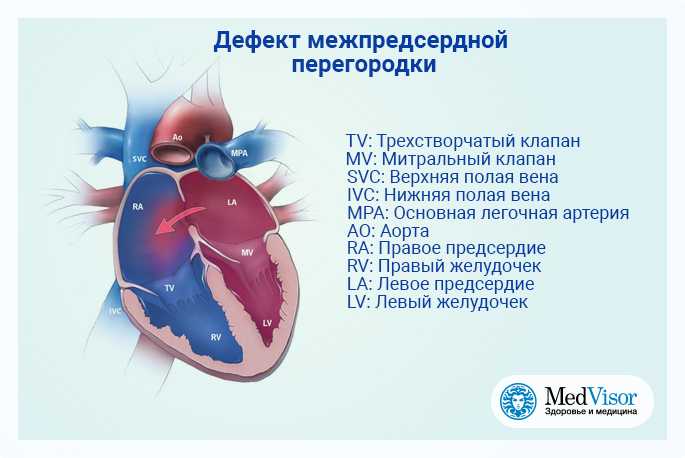 Дефект межпредсердной перегородки (дмпп): причины, лечение, операция