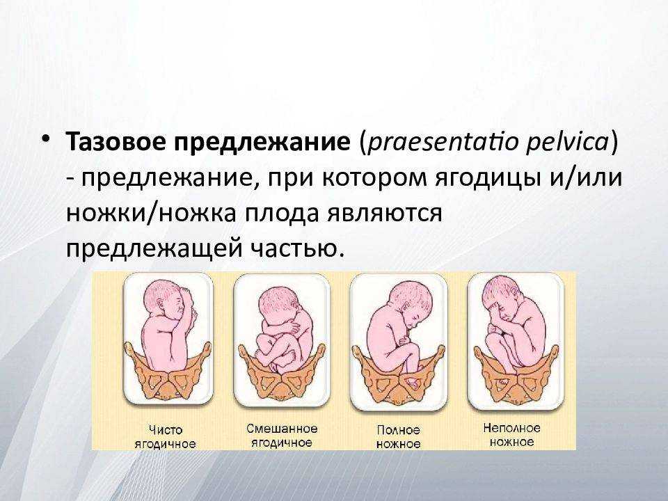 Тазовое предлежание плода: что значит, в чем причины
