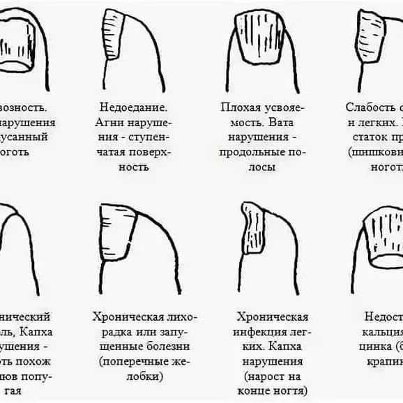 Темные пятна, линии на ногтях и под ногтями, причины, как лечить