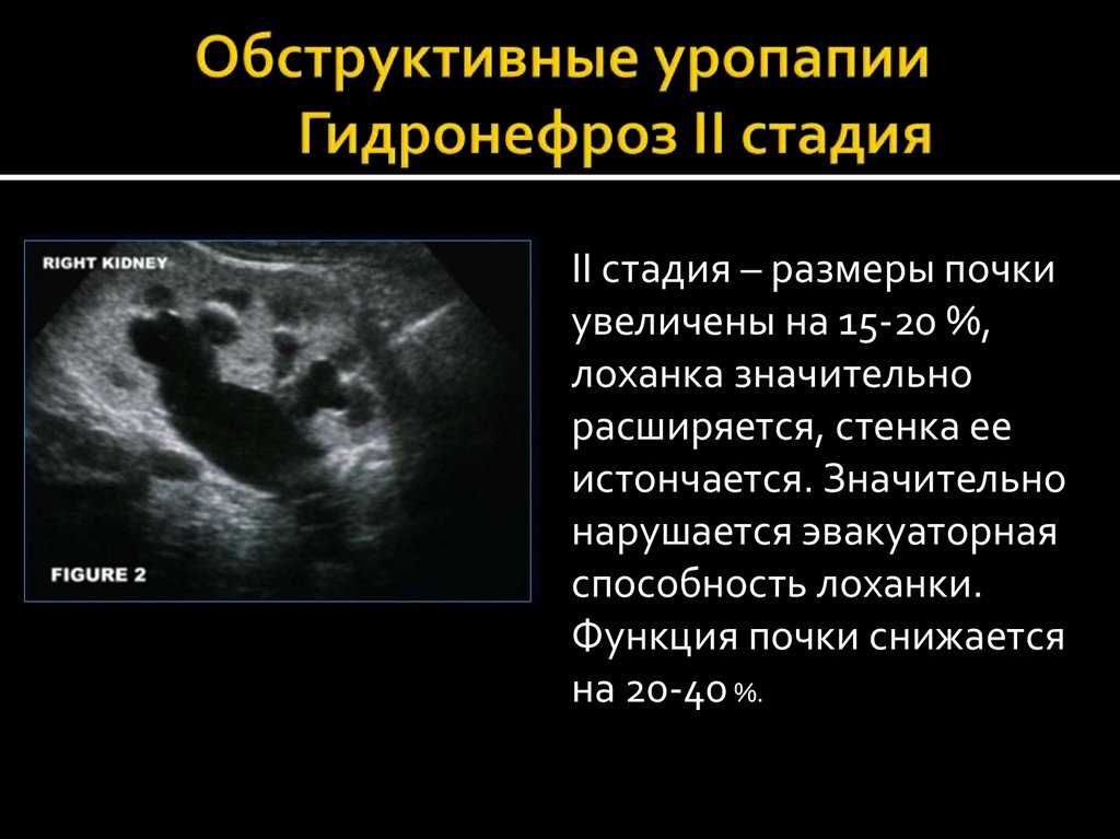 Патологии почек у плода: что и когда показывает экспертное узи при беременности * клиника диана в санкт-петербурге