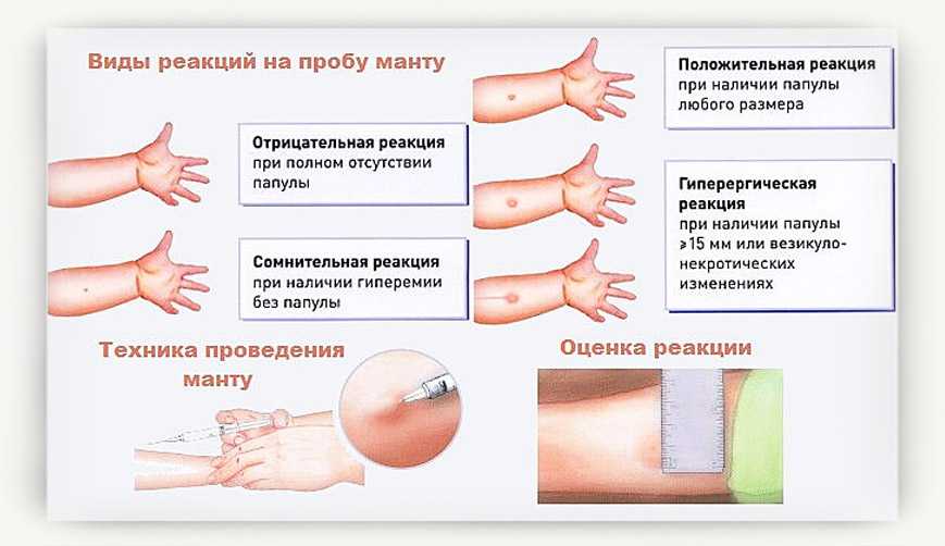 Проба «манту» | детский медицинский центр "чудодети"