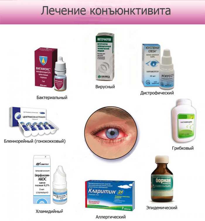 Как отличить вирусный конъюнктивит от бактериального: сходства и различия в симптомах и лечении