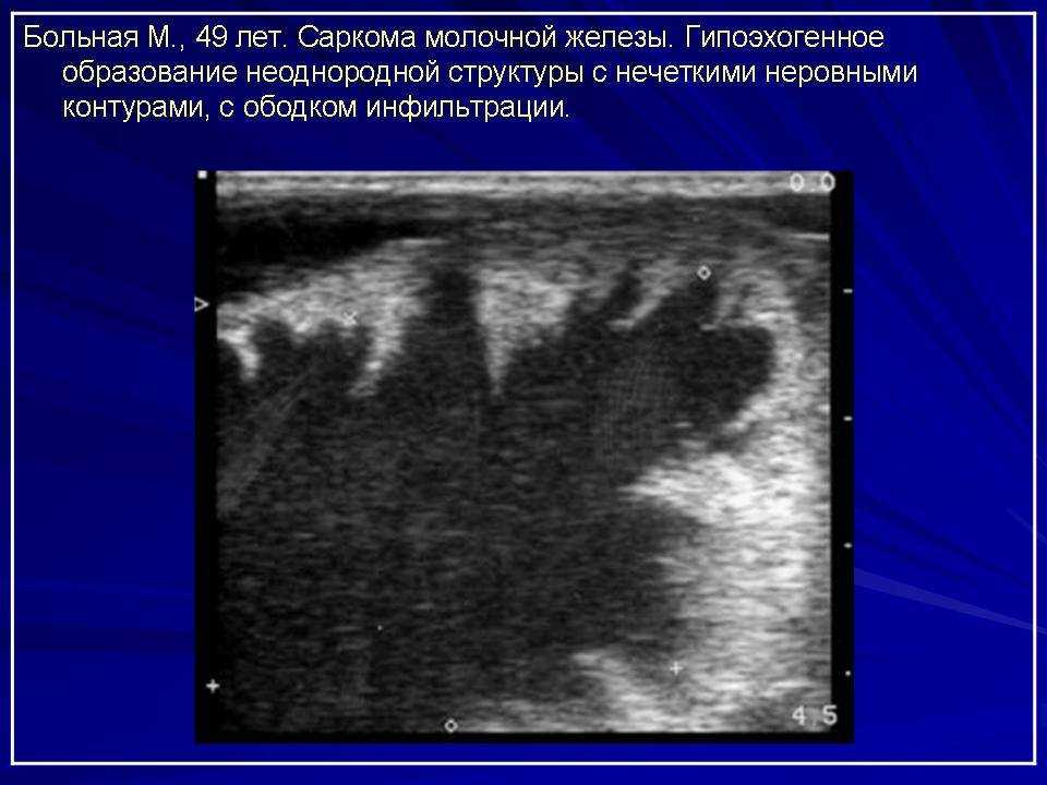 Диффузный фиброаденоматоз молочной железы: причины, симптомы и лечение