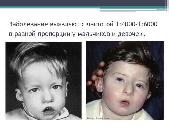 Синдром ди джорджи что это такое: причины, клинические признаки лечение | kvd9spb.ru