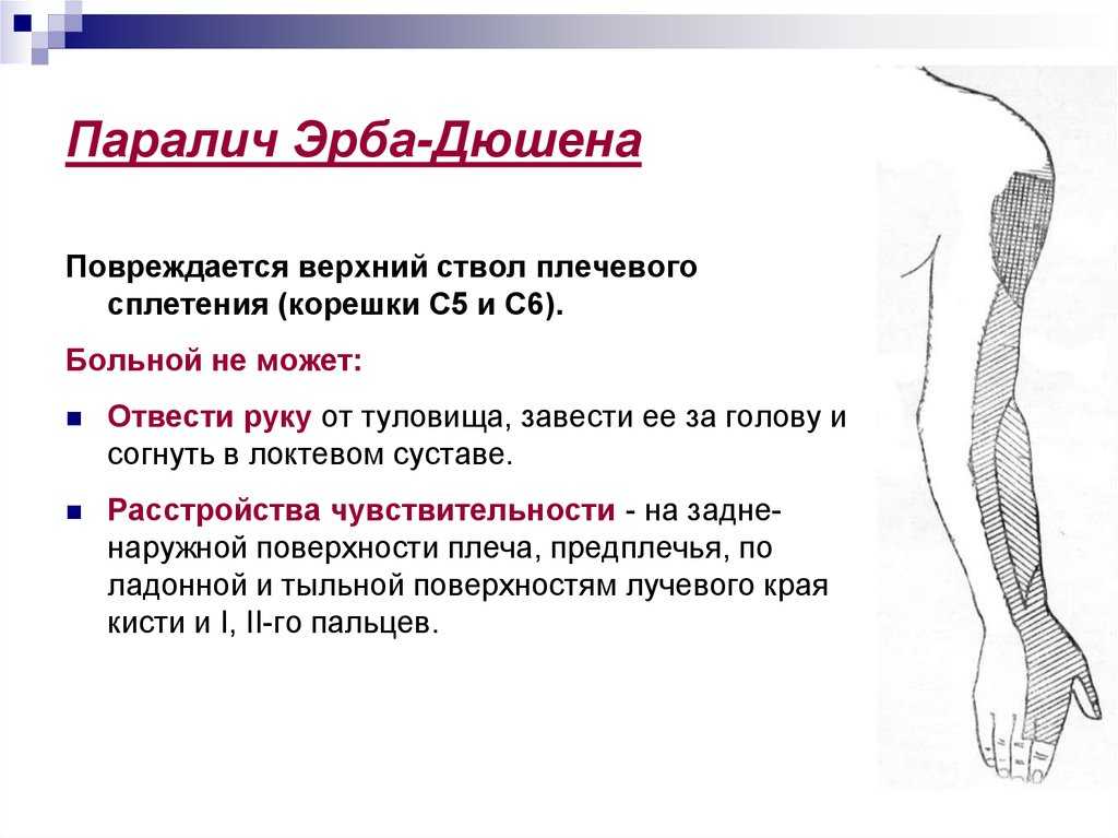 Паралич дюшена-эрба. лечение акушерского пареза дюшена-эрба - навстречу жизни.