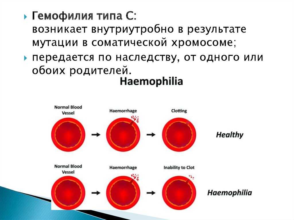 Пример гемофилии