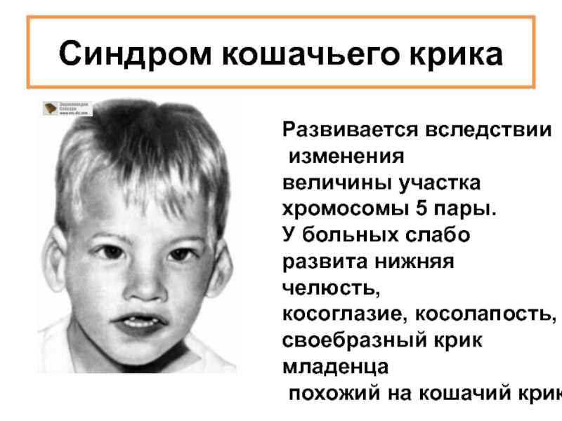 Синдром кошачьего крика что это: диагностика заболевания