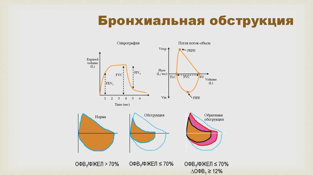 Бронхиальная обструкция. Петля поток объем при бронхиальной астме. Спирограмма обструктивный Тип. Спирограмма легких обструкция. Спирометрия по обструктивному типу.