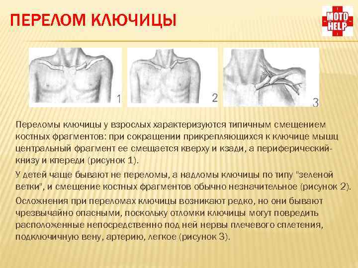 Перелом ключицы: период восстановления при смещении, операция с пластиной, лечение у детей - medside.ru