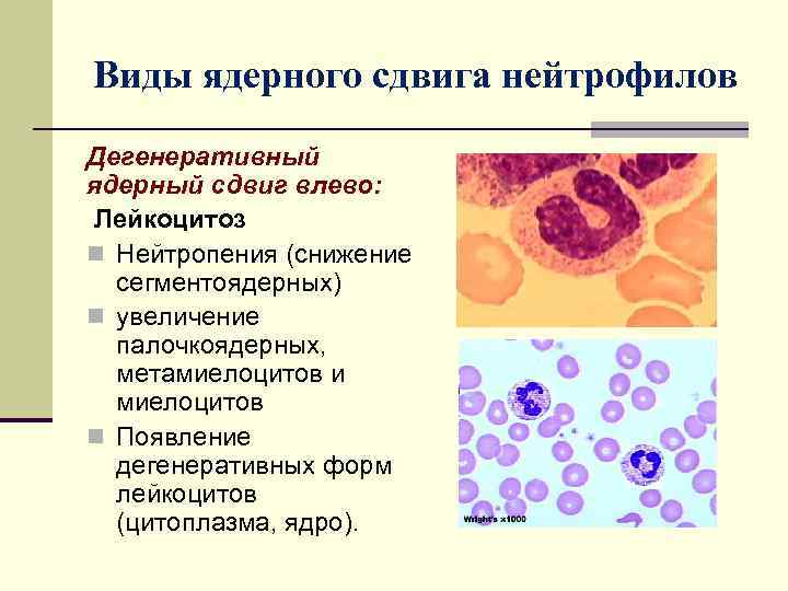 Лейкопения что это, низкие лейкоциты в крови при онкологии – симптомы и причины лейкопении у взрослых | клиники «евроонко»