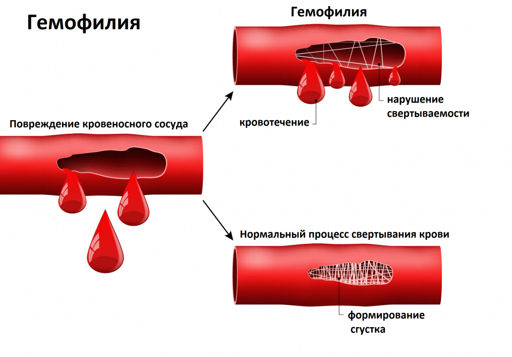 Нарушение свертываемости крови. Нарушение свертывающей системы крови. Наоузение свёртываемости крови.