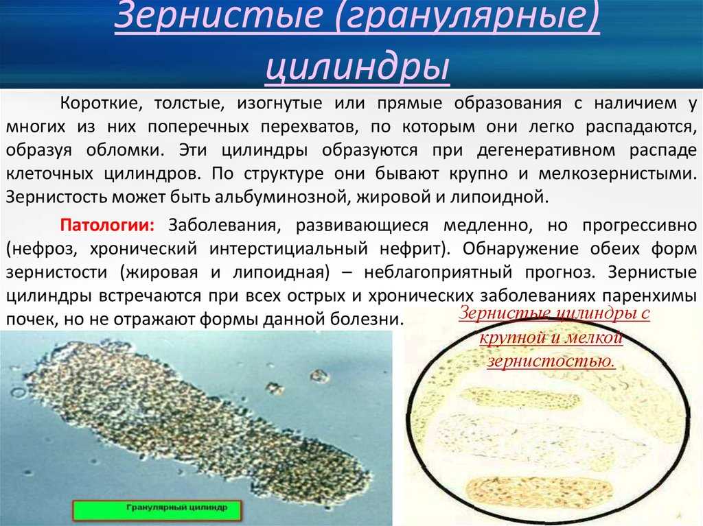 О чем говорят цилиндры в моче: гиалиновые, зернистые, восковидные