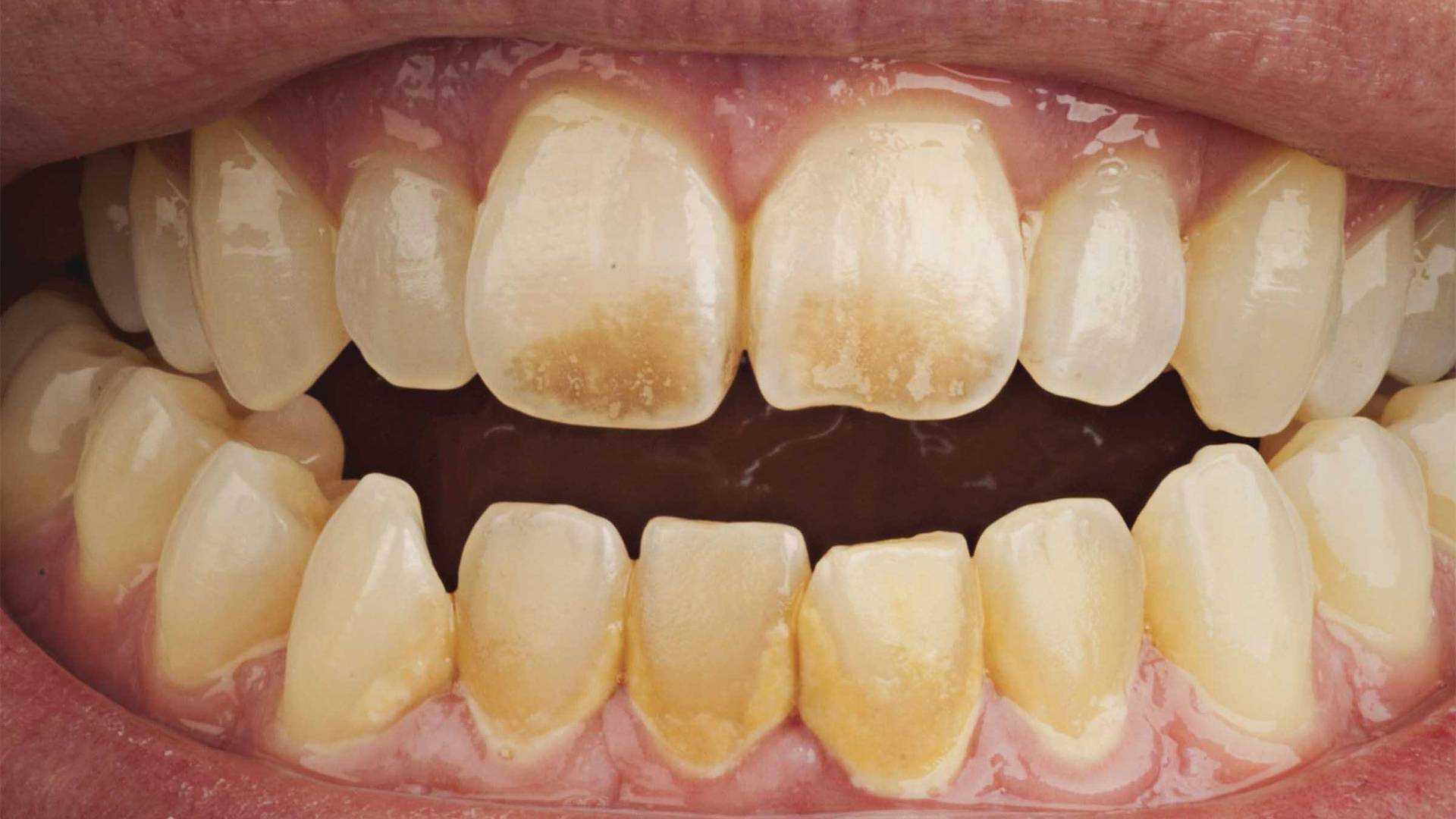 Причины белых пятен на зубах у детей, что делать| colgate®