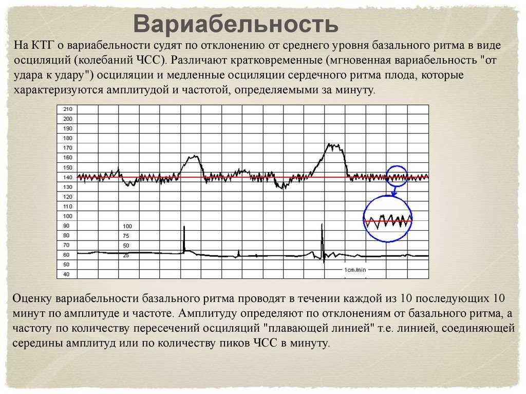 Ктг что это. Норма ЧСС по КТГ. Базальная частота КТГ норма. КТГ норма ритм. Базальный ритм на КТГ норма.