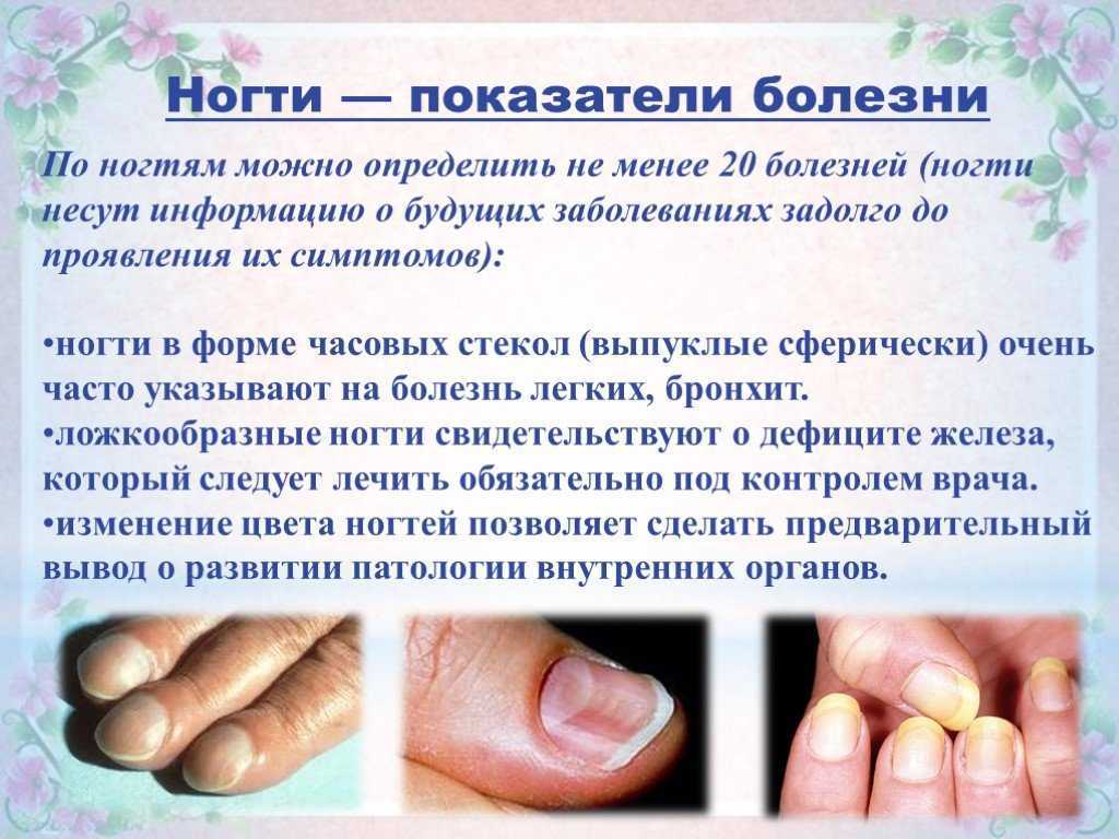 Полоски на ногтях - белые, черные, красные: причины появления, лечение, фото