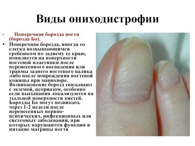 Трамплинообразные ногти коррекция. мк "наращивание ногтей на сложных ногтях"трамплин" (смотрят вверх) ". | маникюр