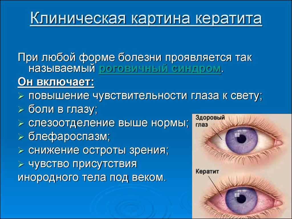 Лечение зуда в глазах
